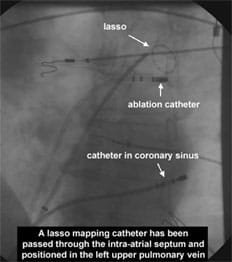 catheter